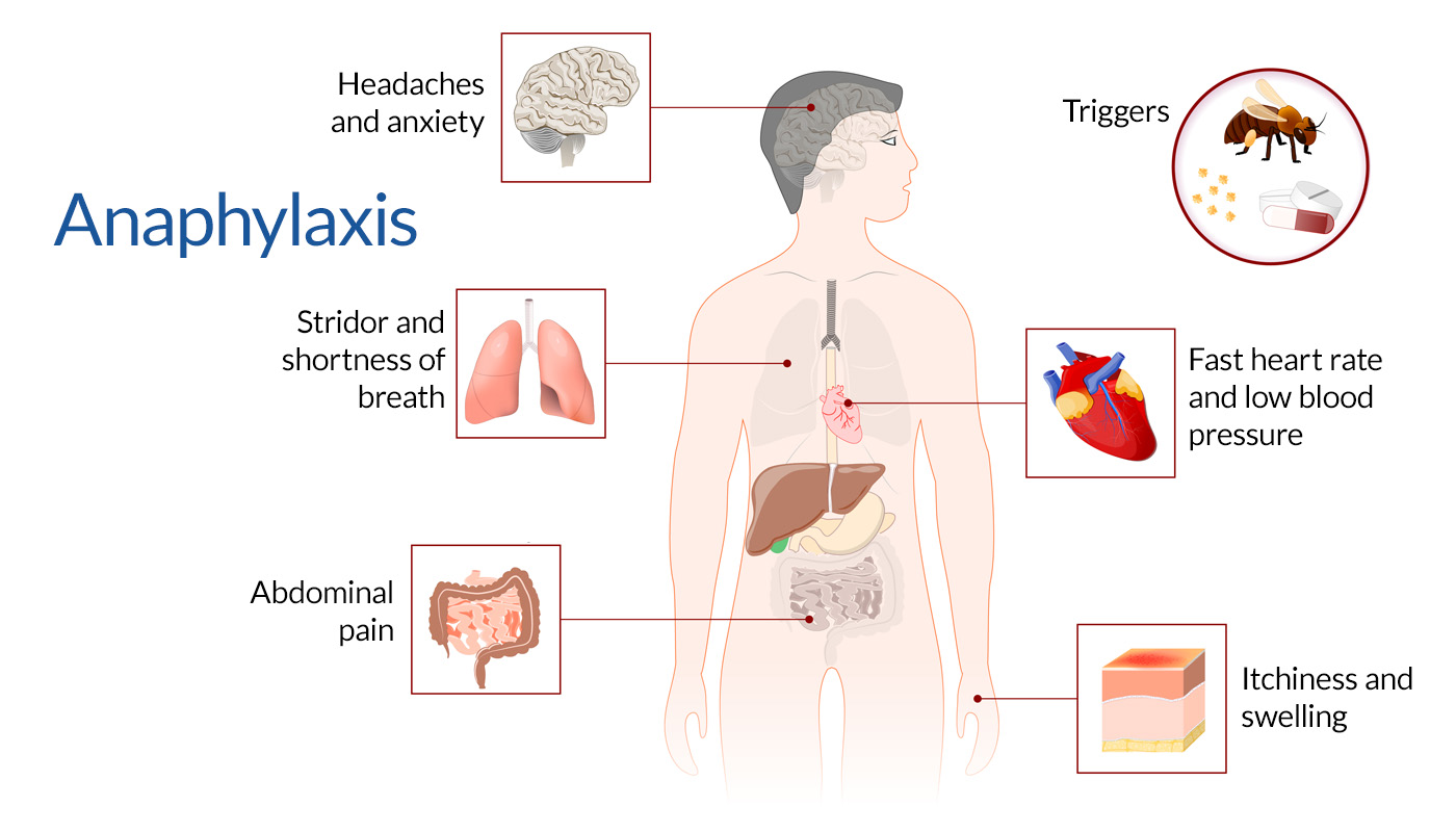 What to Do When Anaphylactic Shock Strikes: Symptoms and Immediate Treatments
